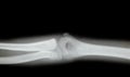 X-ray of a young mans arm Royalty Free Stock Photo