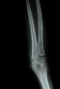 X-ray of a young people arm Royalty Free Stock Photo