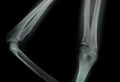 X-ray of a young people arm Royalty Free Stock Photo
