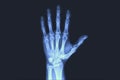 X-rayed human hand. X-ray of hand bones. Royalty Free Stock Photo