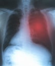 X-Rays film of lungs with virus Covid-19. Medical background pneumonia disease concept