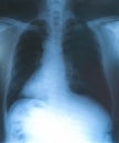 X-Rays film of lungs with virus Covid-19. Medical background pneumonia disease concept