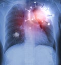 X-Rays film of lungs with virus Covid-19, responsible for Asian flu outbreak