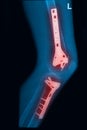 X Rays image broken thigh and leg with implant