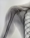 X-rays image of the painful or injury shoulder joint, shoulder dislocation