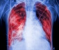 X-rays with lungs marked red color Royalty Free Stock Photo