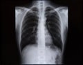 X-rays of the spine and chest