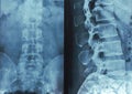 X-rays of the spine