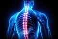 x-rays of the spine, Scoliosis film x-ray show spinal bend in teenager patient