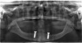 X-rays of teeth with implants