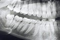 X-rays teeth