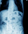 Xray abdomen