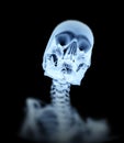 Xray Bone 4 Royalty Free Stock Photo