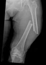 Xray of Broken Femur Bone