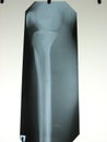 xray of a broken leg bone Royalty Free Stock Photo
