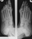 Xray of bunions