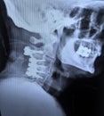 Xray cervical spine fixation hardware after car accident