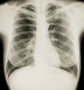 Xray of chest, normal Royalty Free Stock Photo
