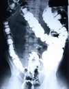Xray/Colon Royalty Free Stock Photo