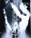 Xray/colon Royalty Free Stock Photo