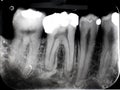 Xray dental film amalgam filling Royalty Free Stock Photo