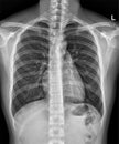 Xray for diagnosis of pneumonia, tuberculosis TB and silicosis.