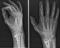 Xray of epiphysial radial fracture reduced with permanent synthetic means Royalty Free Stock Photo