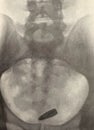 Xray examination abdomen pelvis gunshot war victim