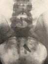 Xray examination abdomen pelvis gunshot war victim
