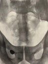 Xray examination abdomen pelvis shrapnel war victim