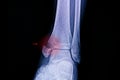 Xray film of an ankle with medial malleolus fracture Royalty Free Stock Photo