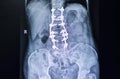 Xray film of a back of a patient with laminectomy