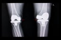 Xray film of both knees arthroplasty