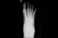 Xray film of a foot of the patient