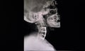 Xray film of a neck of a patient with plate and screws fixations