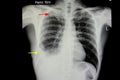 pulmonary tuberculosis with pleural effusion