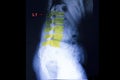 compression fracture of lambar spine