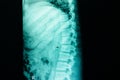 compression fracture of lumbar spine Royalty Free Stock Photo