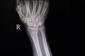 Xray film of fracture wrist bones Royalty Free Stock Photo