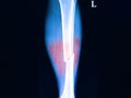 fractures of leg bones