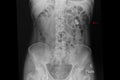 Xray film of a patient with kidney stones