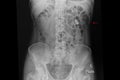 Xray film of a patient with kidney stones Royalty Free Stock Photo