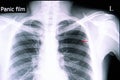 spontaneous pneumothorax