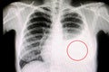 Pleural Effusion