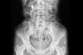 Xray film of a patient with multiple kidney and ureteric stones