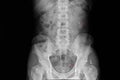 Xray film of a patient with renal and ureteric stone