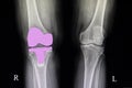 Total knee arthroplasty