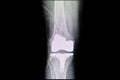 Total knee arthroplasty