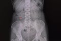 Xray film of a patient with a ureteric stone