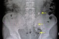 xray film of a patient with ureteric stones